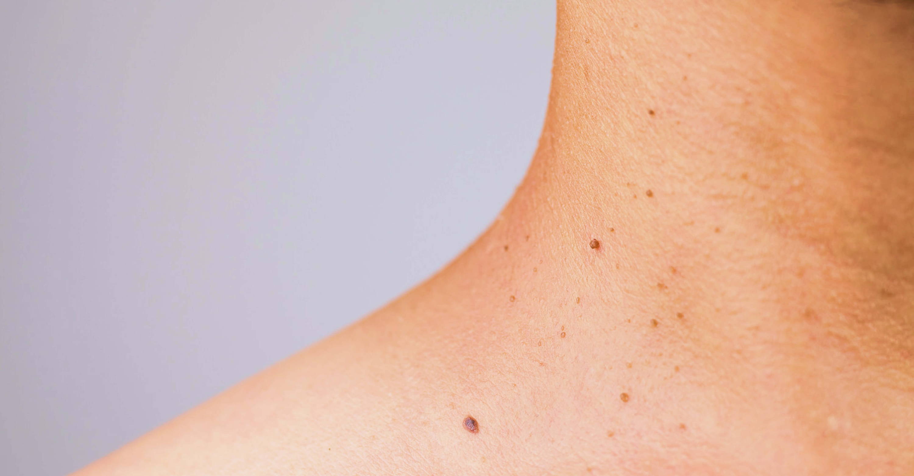 Skin Tag vs. Wart Understanding the Difference Skintify